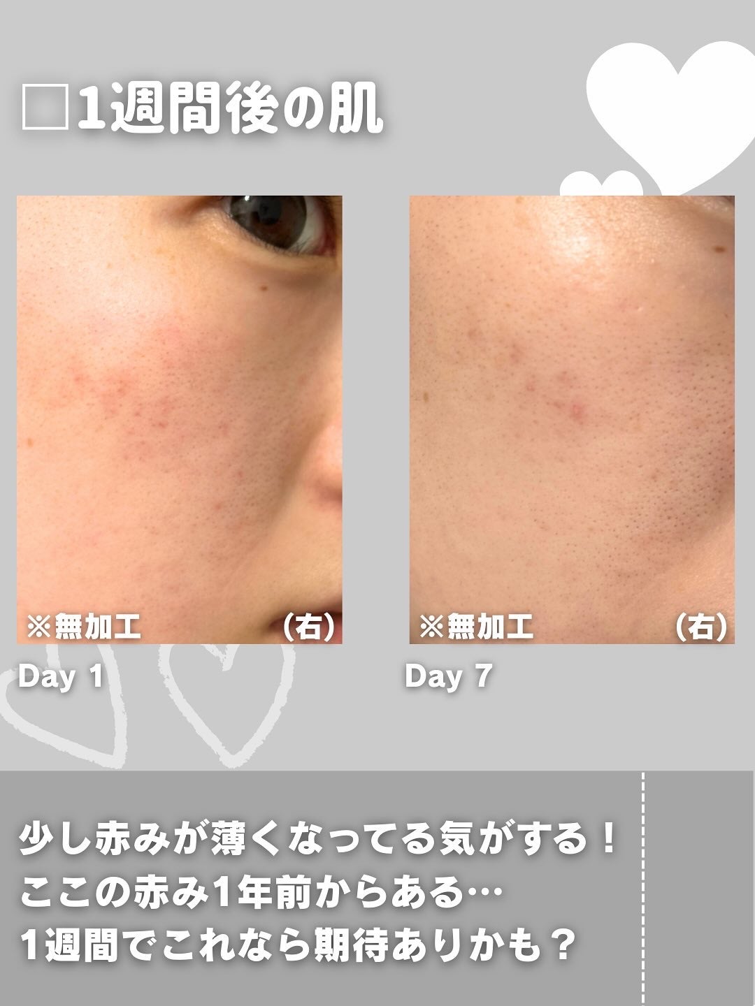 ダーマジェンシー ゼロカ81 セラム/DERMAGENCY/美容液を使ったクチコミ(4枚目)