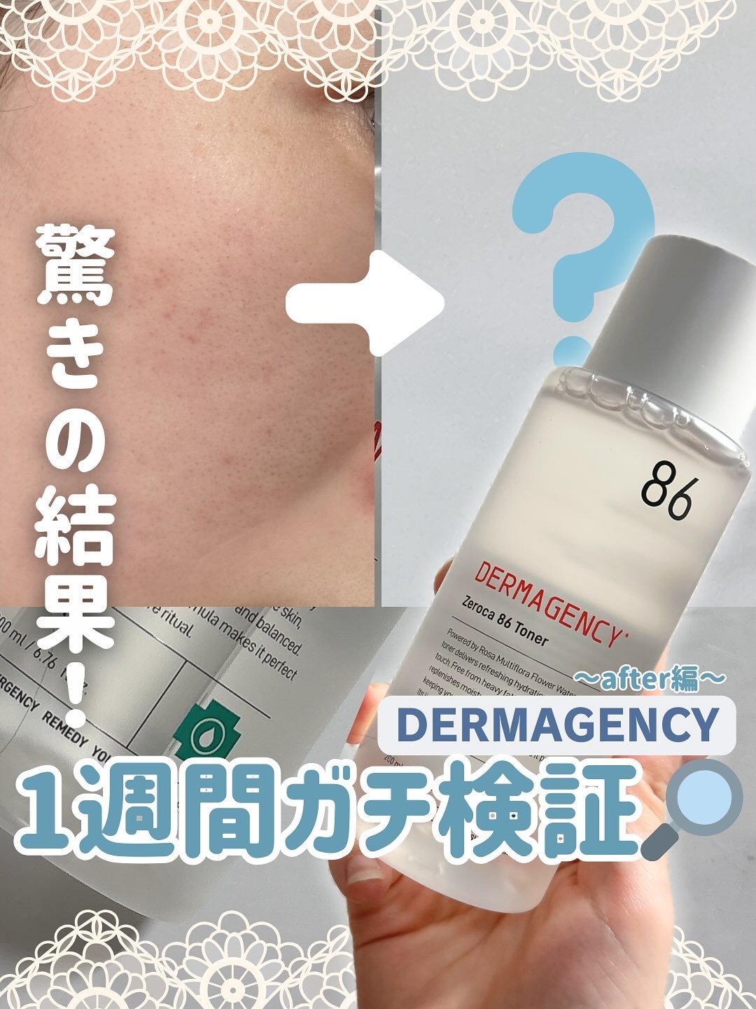 ダーマジェンシー ゼロカ86 トナー/DERMAGENCY/化粧水を使ったクチコミ(1枚目)