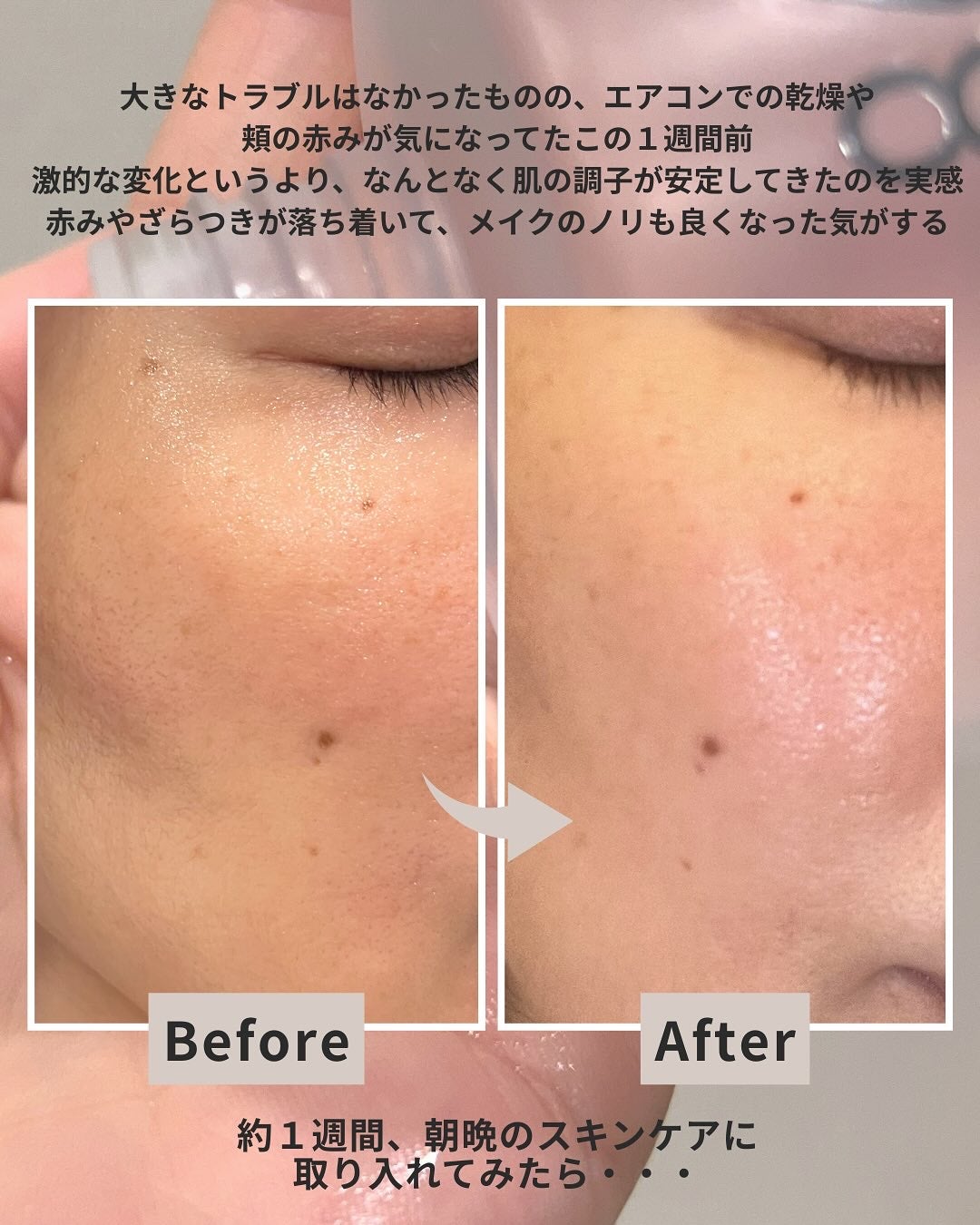 ダーマジェンシー ゼロカ86 トナー/DERMAGENCY/化粧水を使ったクチコミ(4枚目)