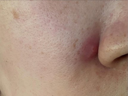 ダーマジェンシー ゼロカ86 トナー/DERMAGENCY/化粧水を使ったクチコミ(7枚目)