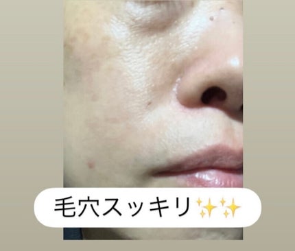 弱酸性毛穴収縮ニドソープ/ODELOI/その他洗顔料を使ったクチコミ(6枚目)