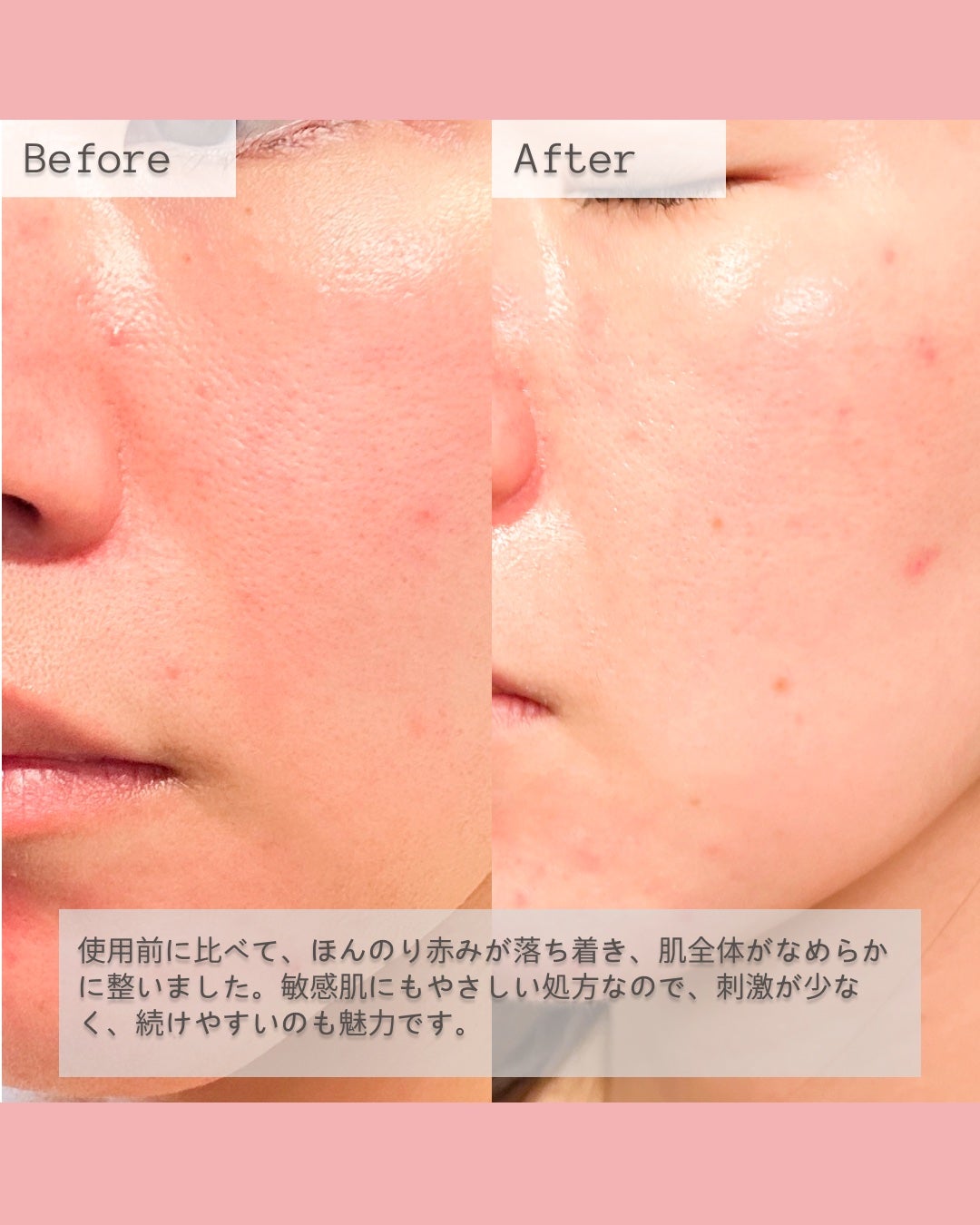 ダーマジェンシー ゼロカ86 トナー/DERMAGENCY/化粧水を使ったクチコミ(4枚目)