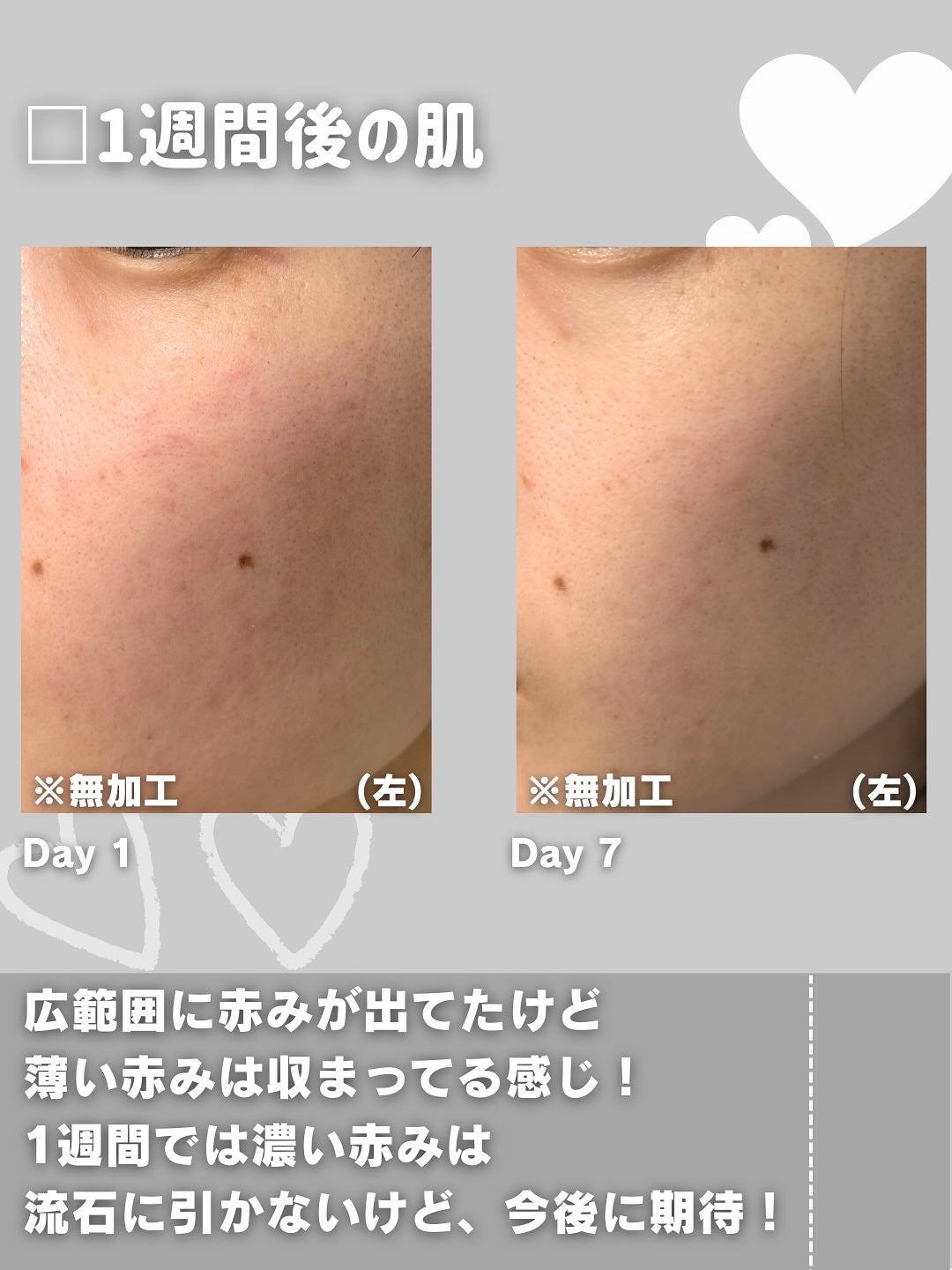 ダーマジェンシー ゼロカ81 セラム/DERMAGENCY/美容液を使ったクチコミ(5枚目)