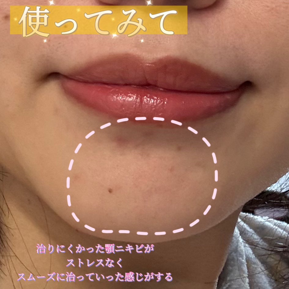 ダーマジェンシー ゼロカ81 セラム/DERMAGENCY/美容液を使ったクチコミ(5枚目)