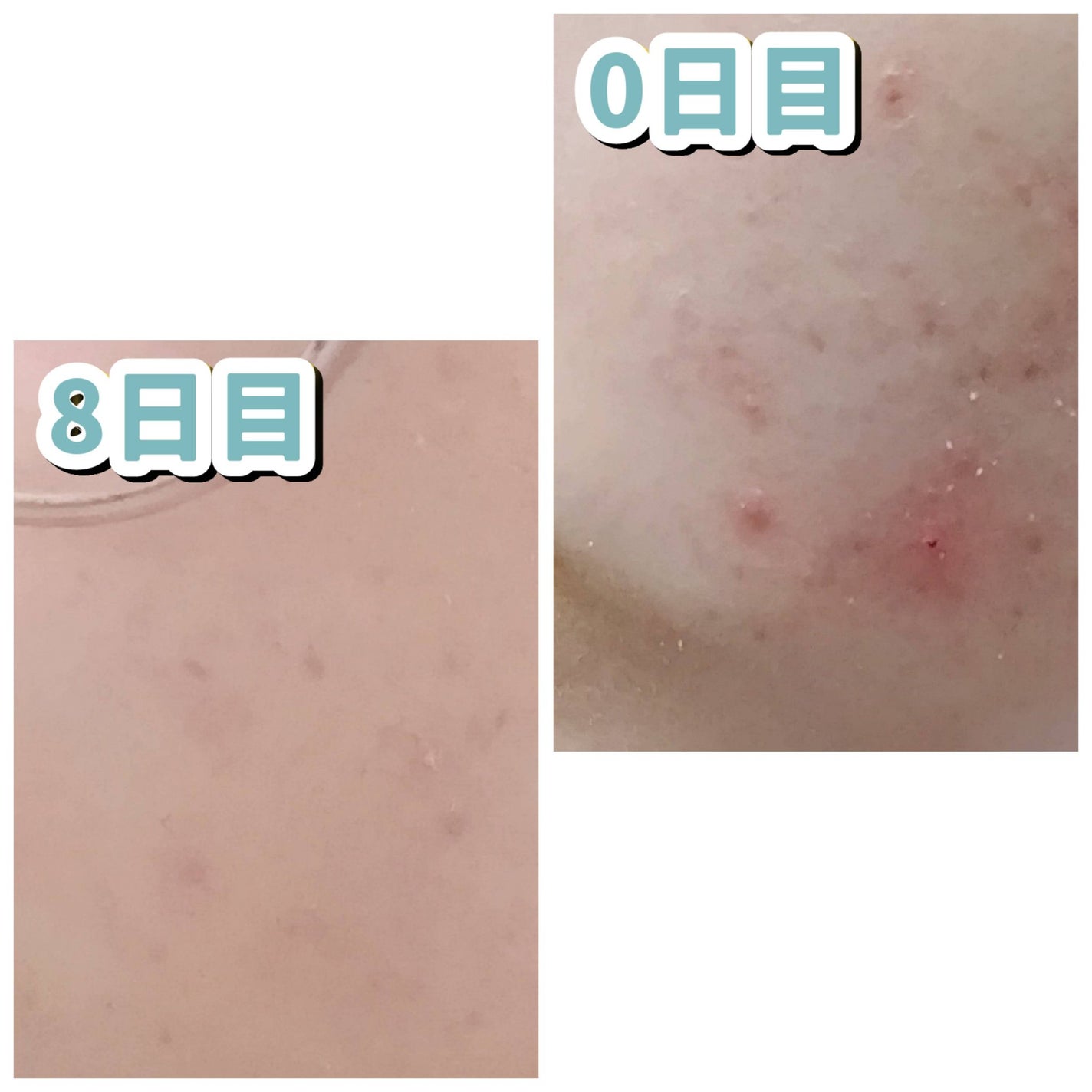 FEG アゼライン酸 15%配合 クリアスキンクリームA /FEG/フェイスクリームを使ったクチコミ(3枚目)