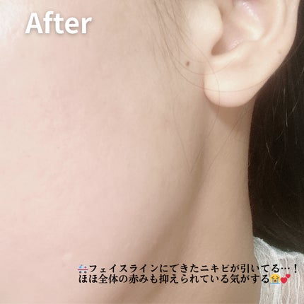 ダーマジェンシー ゼロカ81 クリーム/DERMAGENCY/フェイスクリームを使ったクチコミ(3枚目)