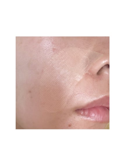 IC.U HA マイクロパッチ AX フィラー/ドクターフィルコスメティクス/アイケア・アイクリームを使ったクチコミ(5枚目)