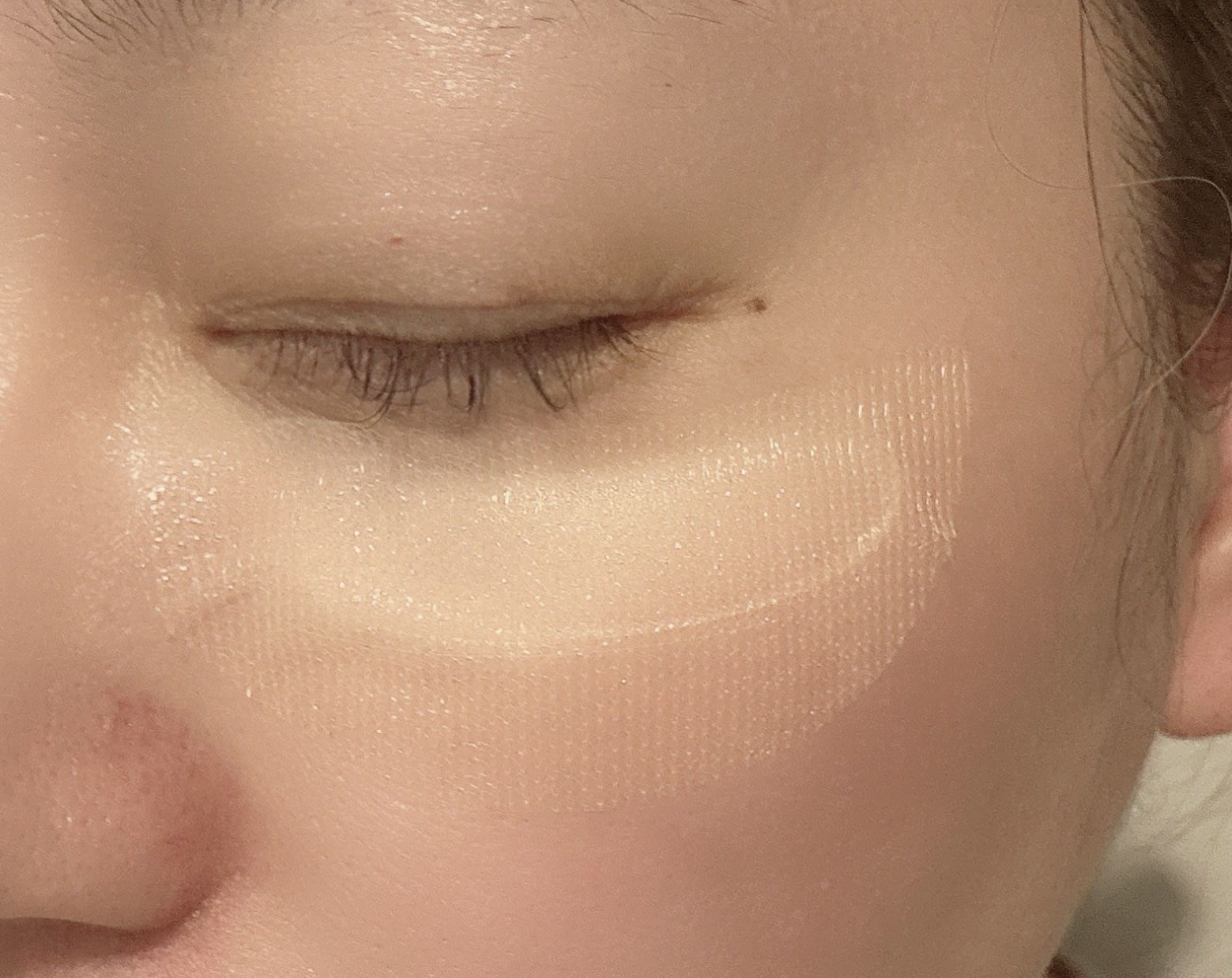 IC.U HA マイクロパッチ AX フィラー/ドクターフィルコスメティクス/アイケア・アイクリームを使ったクチコミ（3枚目）