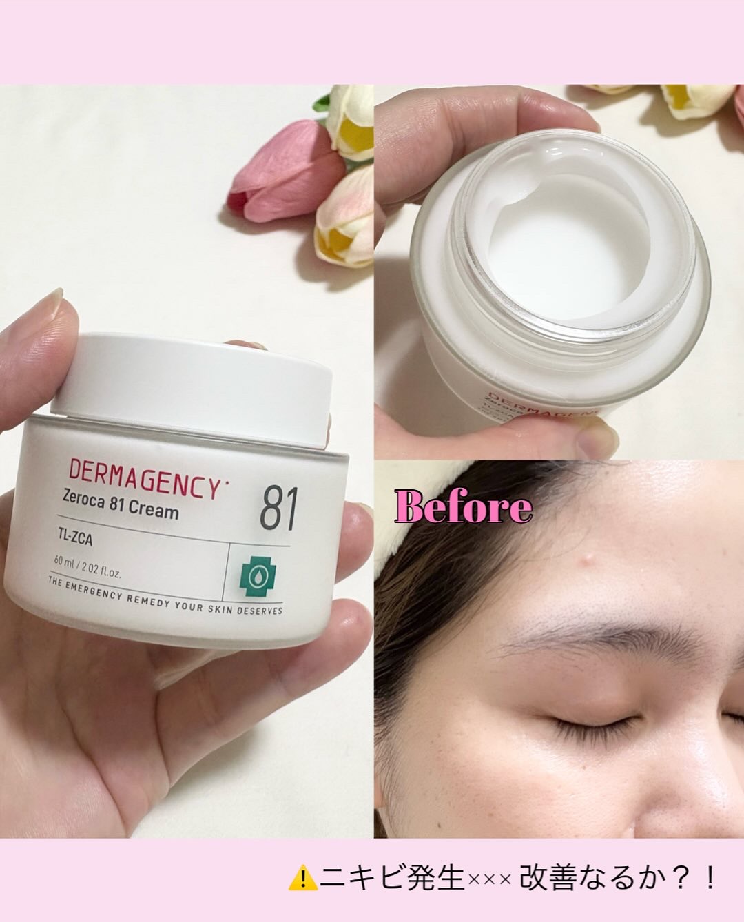 ダーマジェンシー ゼロカ81 クリーム/DERMAGENCY/フェイスクリームを使ったクチコミ（3枚目）