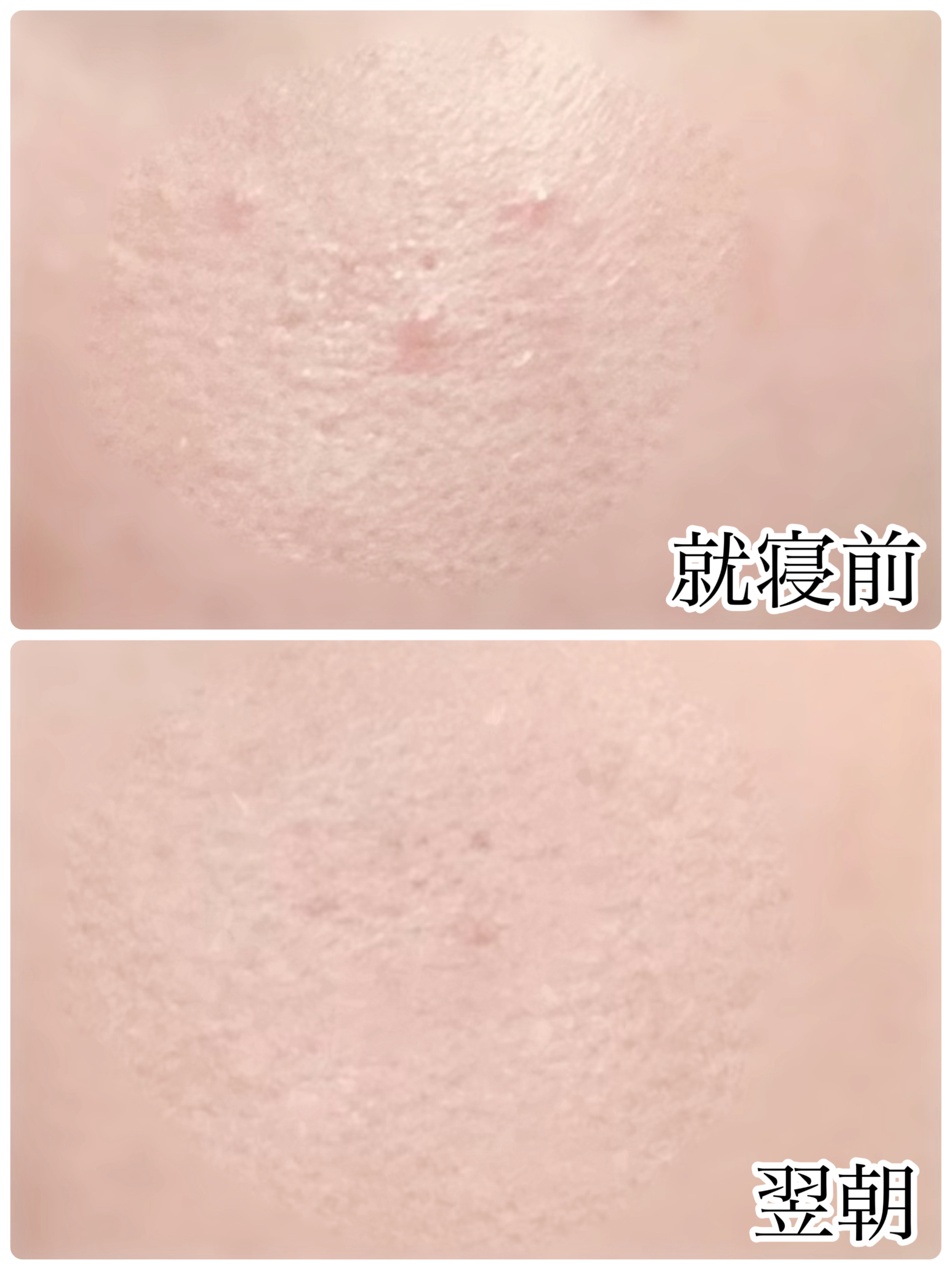 薬用 しみ 集中対策 美容液/メラノCC/美容液を使ったクチコミ（2枚目）