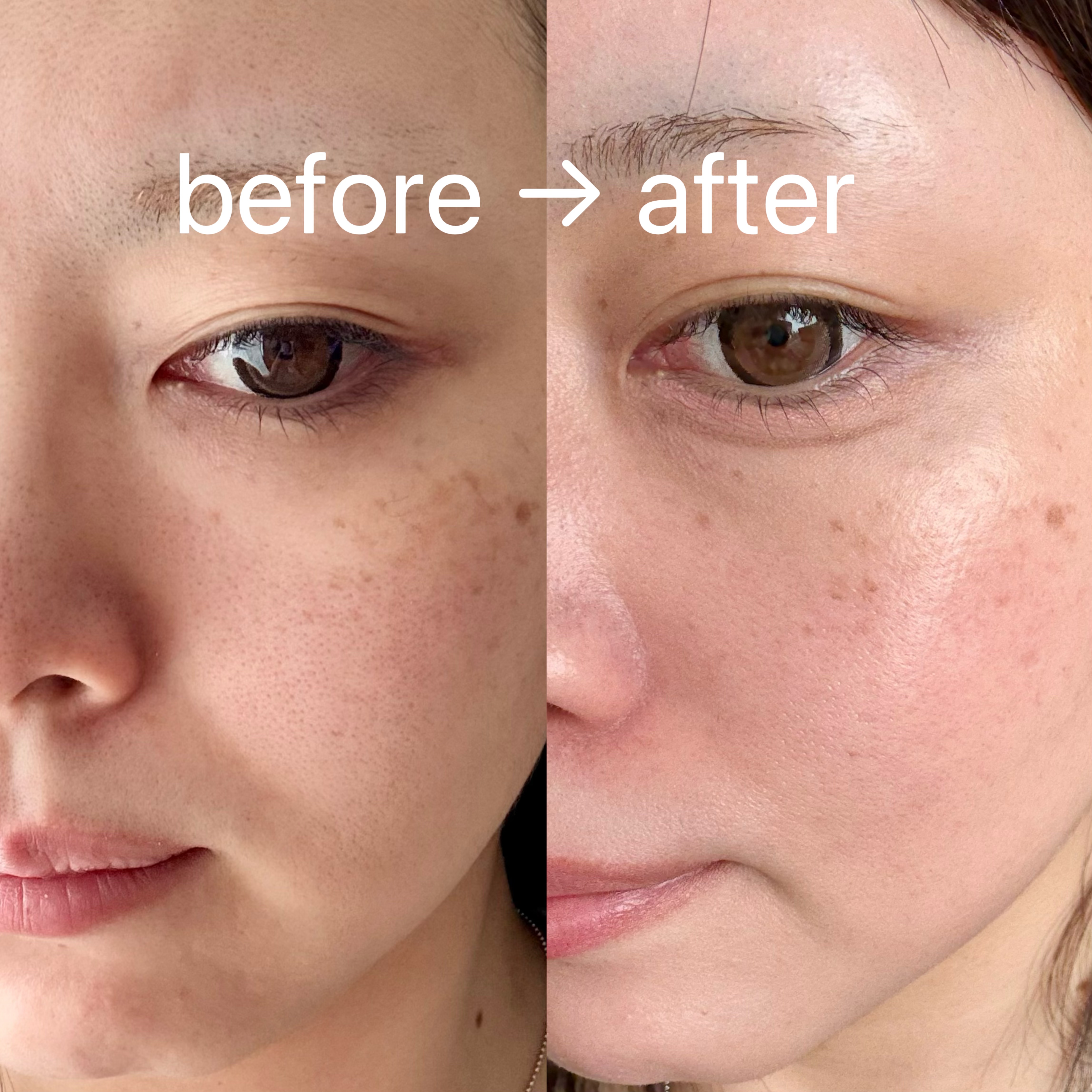 C×AZ ダーマインショット200/ESIENCE/美容液を使ったクチコミ（3枚目）