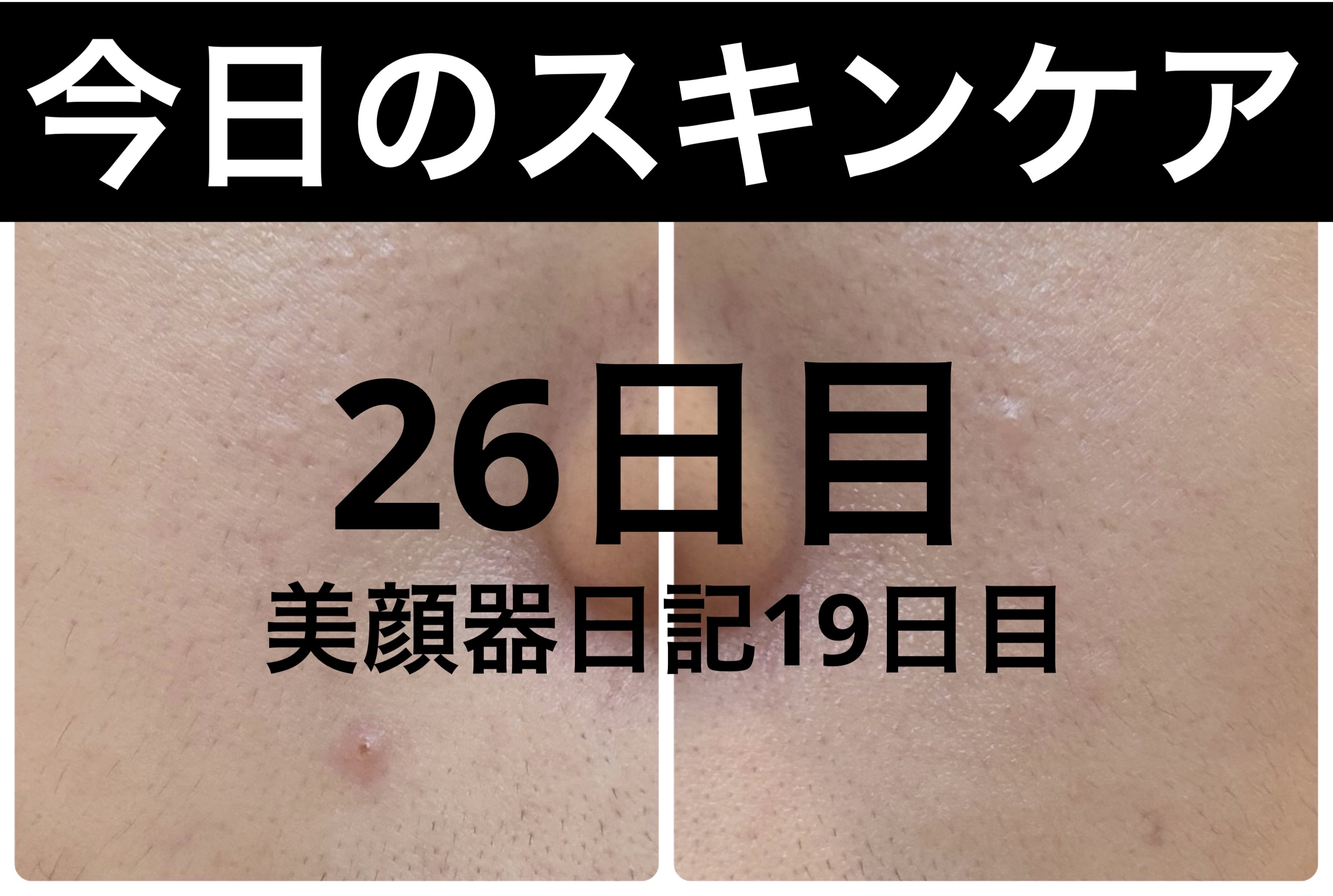 薬用雪肌精 ブライトニング クレンジング オイル[医薬部外品]/雪肌精/オイルクレンジングを使ったクチコミ（1枚目）