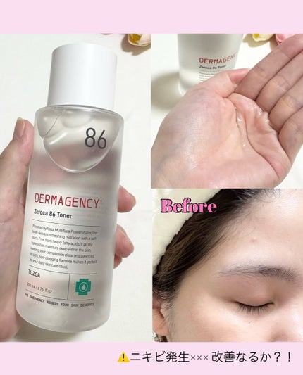 ダーマジェンシー ゼロカ86 トナー/DERMAGENCY/化粧水を使ったクチコミ(3枚目)