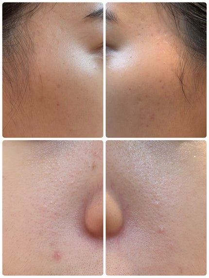 AGE-R ブースタープロ ホワイト(ミニ)/MEDICUBE/美顔器・マッサージを使ったクチコミ(2枚目)