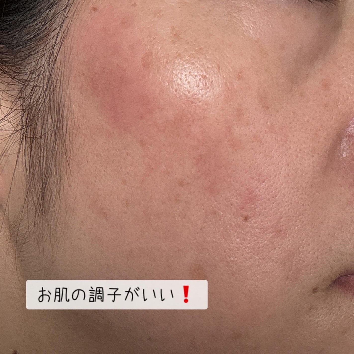 ダーマジェンシー ゼロカ81 クリーム/DERMAGENCY/フェイスクリームを使ったクチコミ(4枚目)