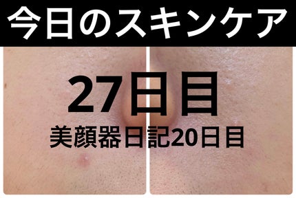 AGE-R ブースタープロ ホワイト(ミニ)/MEDICUBE/美顔器・マッサージを使ったクチコミ(1枚目)