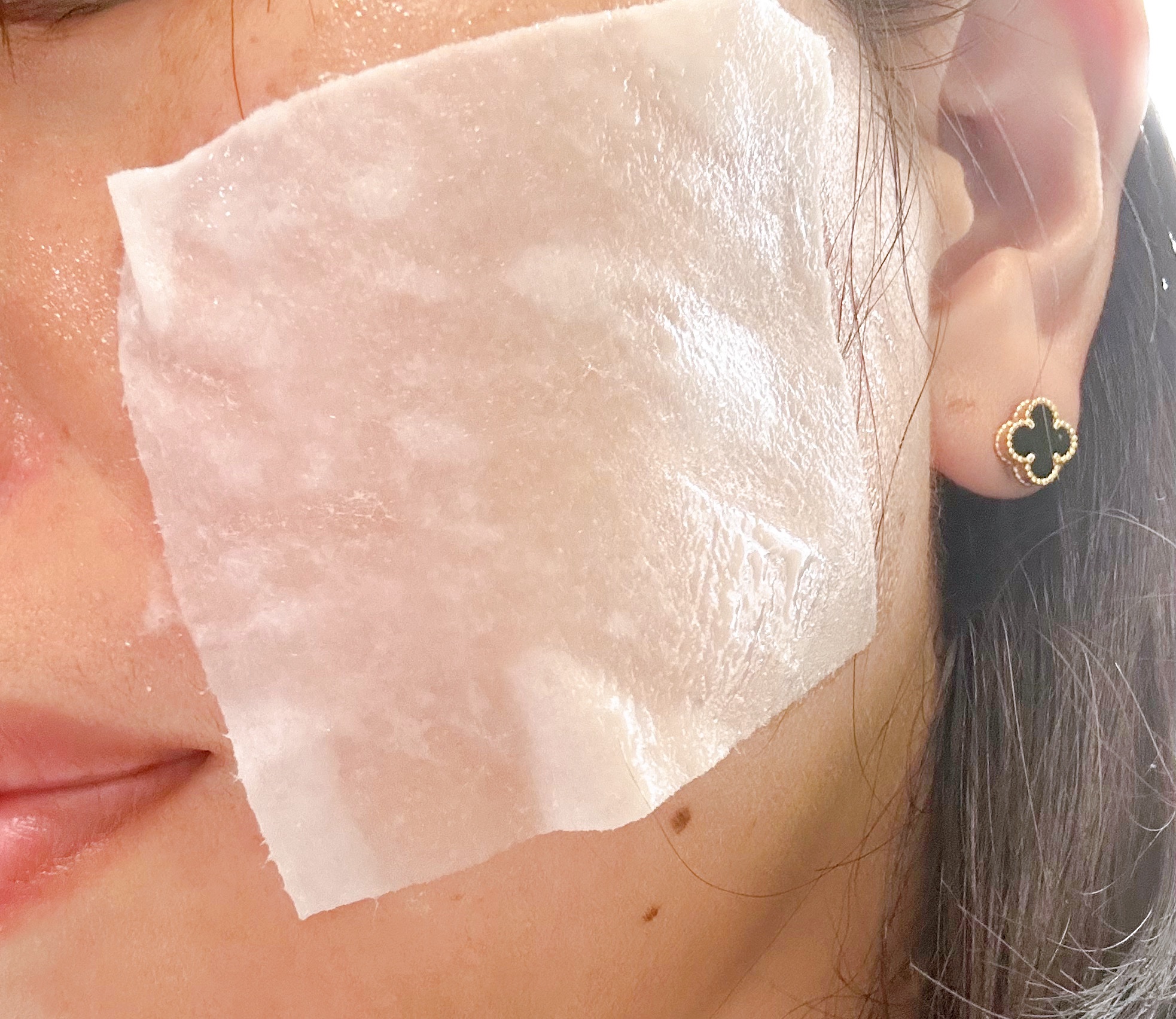 リズム ピコレーザー ニードルスポットパック/RISM/シートマスク・パックを使ったクチコミ（3枚目）