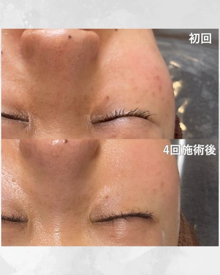 ほし⭐︎フォロバします♪(元美容部員) on LIPS 「•#シミケア記録去年の秋🍂から今年の冬❄️にかけて、5ヶ月間通..」(6枚目)