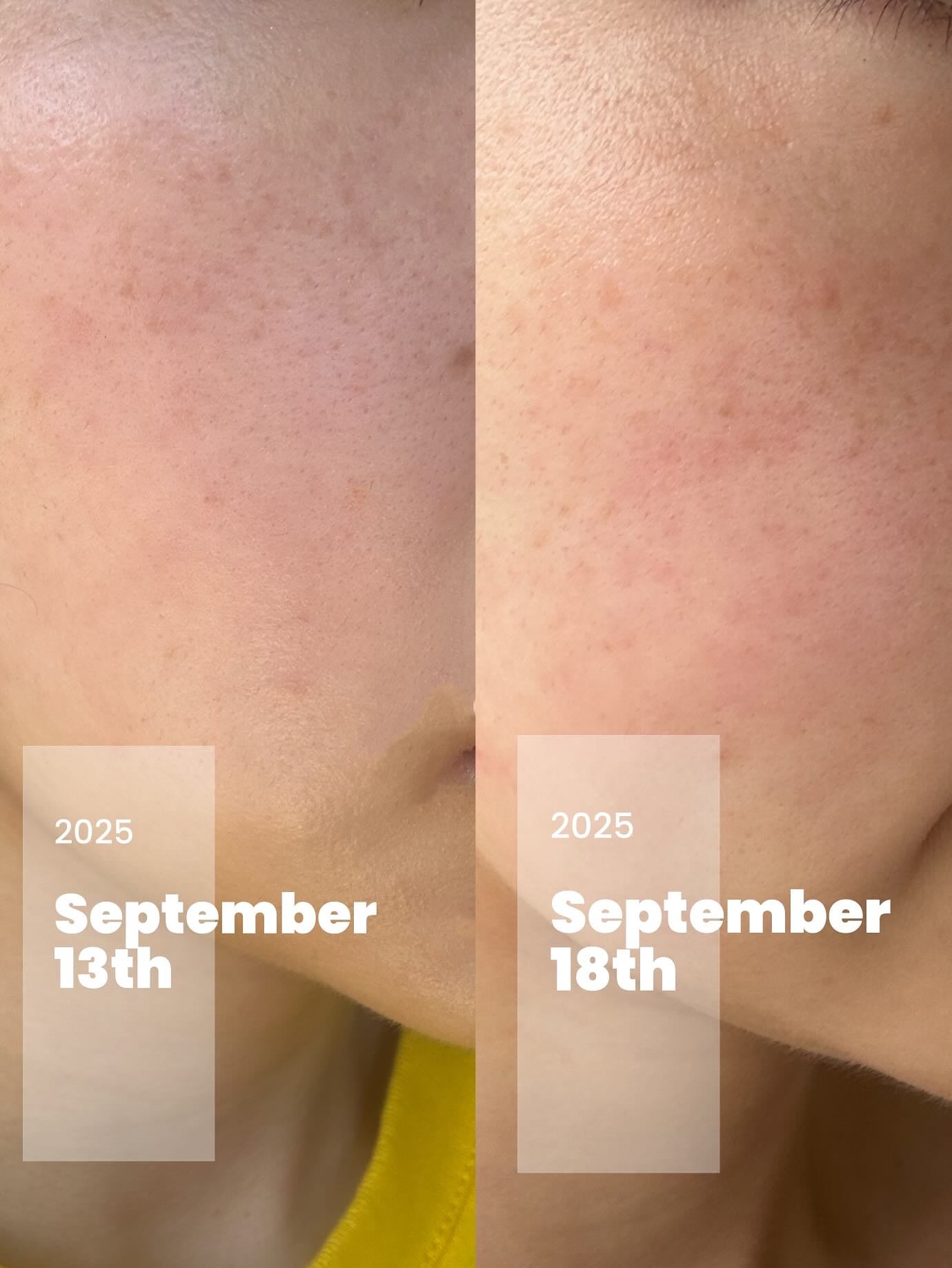 ã«ãããð¥ on LIPS ãâš5çªçœçã°ã«ã¿ããªã³100ÃTXA10éäžããŒãã³ã°çŸå®¹æ¶²âš..ãïŒ3æç®ïŒ