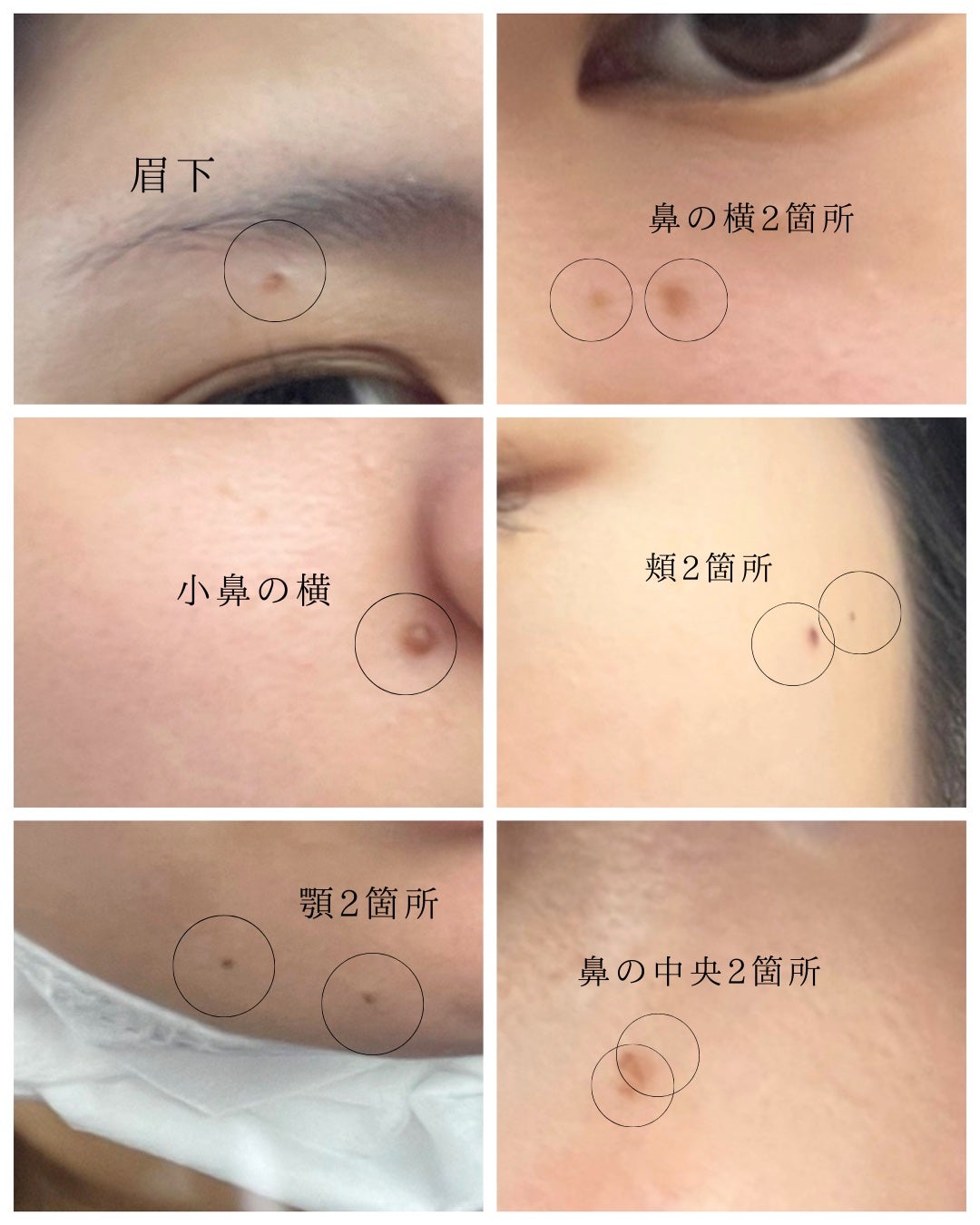 Eちゃん フォロバ♡ on LIPS 「ほくろ除去しました!長文になっちゃったけど参考になれば嬉しいな..」(3枚目)