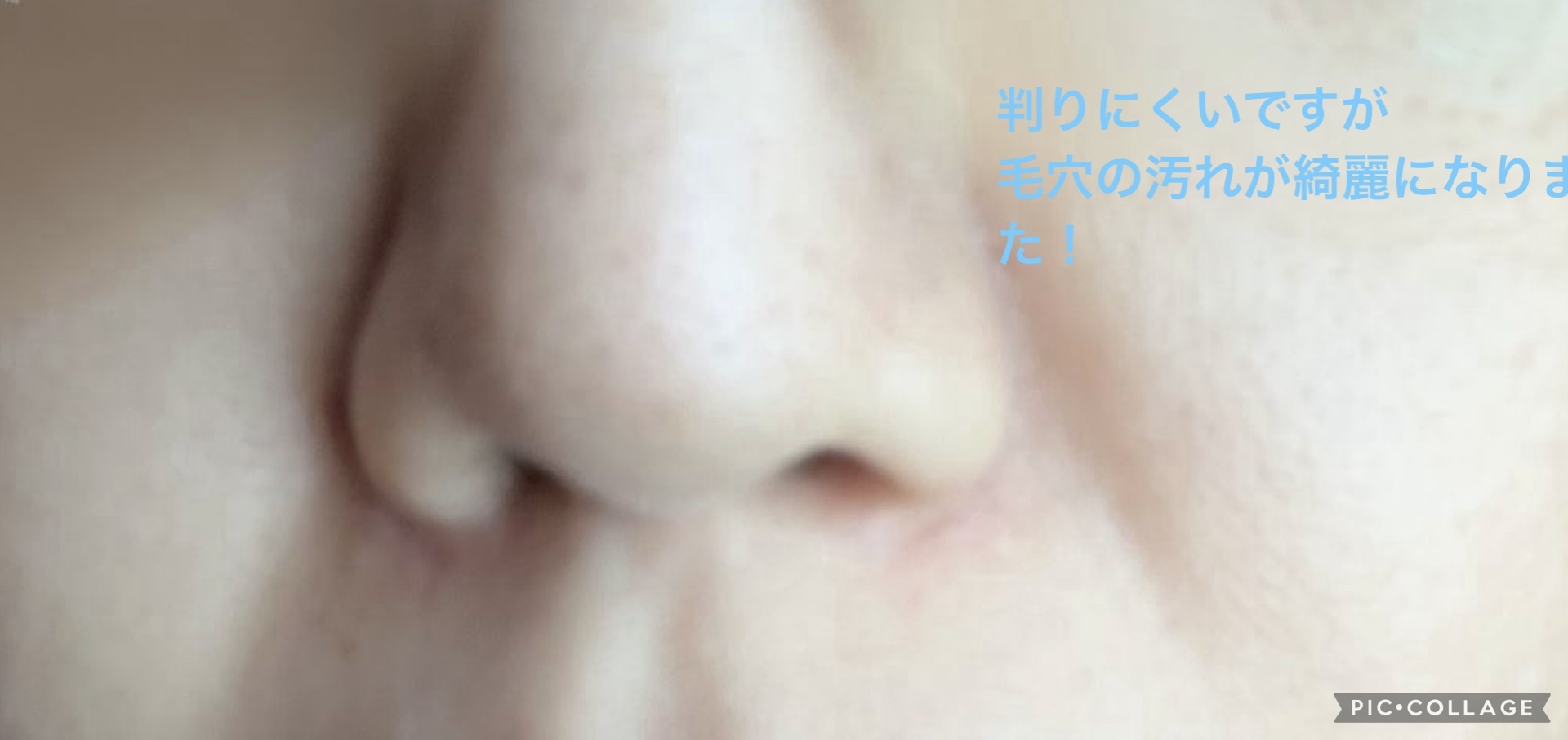 ダーマセラム アゼライン酸15％/SHIMBI METHOD/美容液を使ったクチコミ（2枚目）