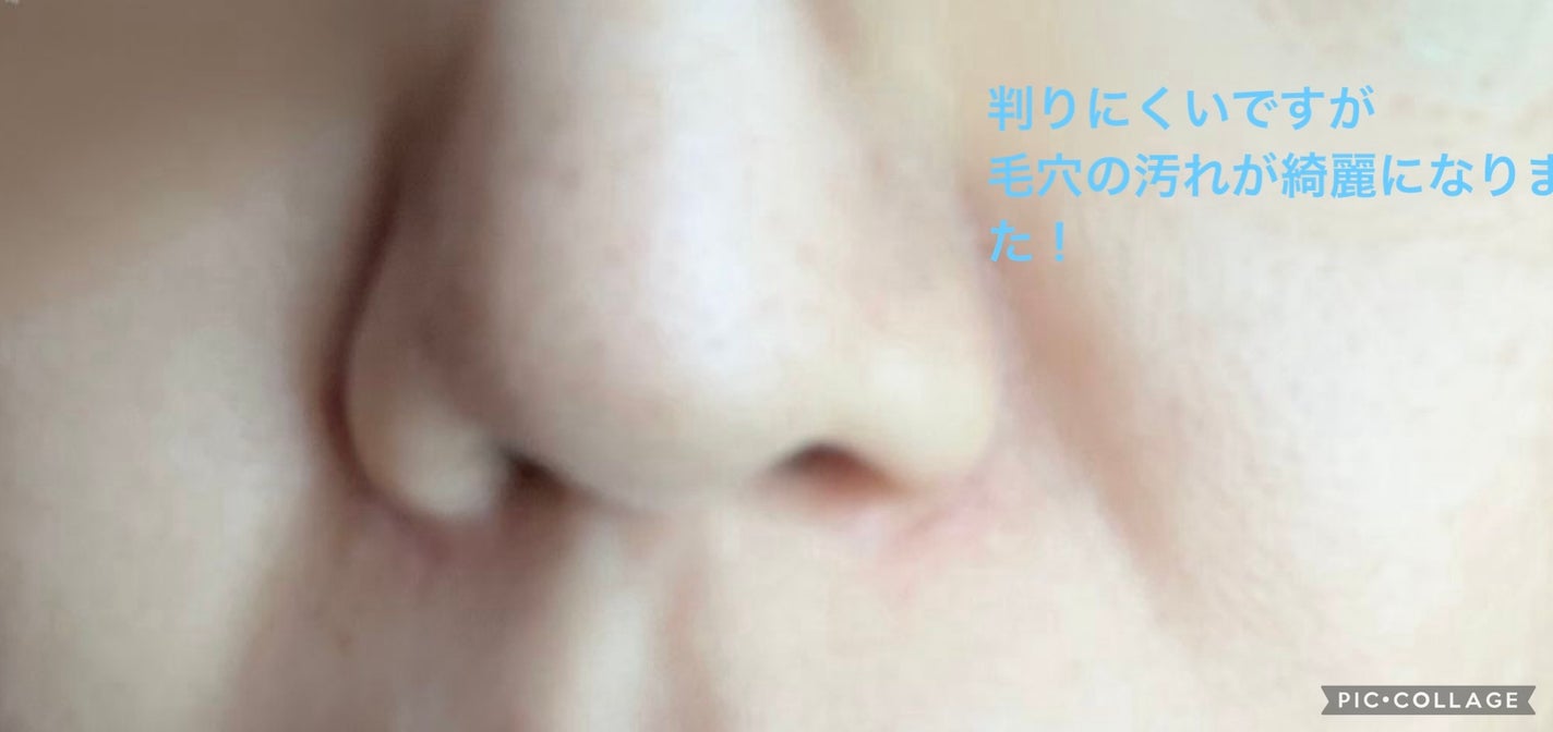 ダーマセラム アゼライン酸15%/SHIMBI METHOD/美容液を使ったクチコミ(2枚目)