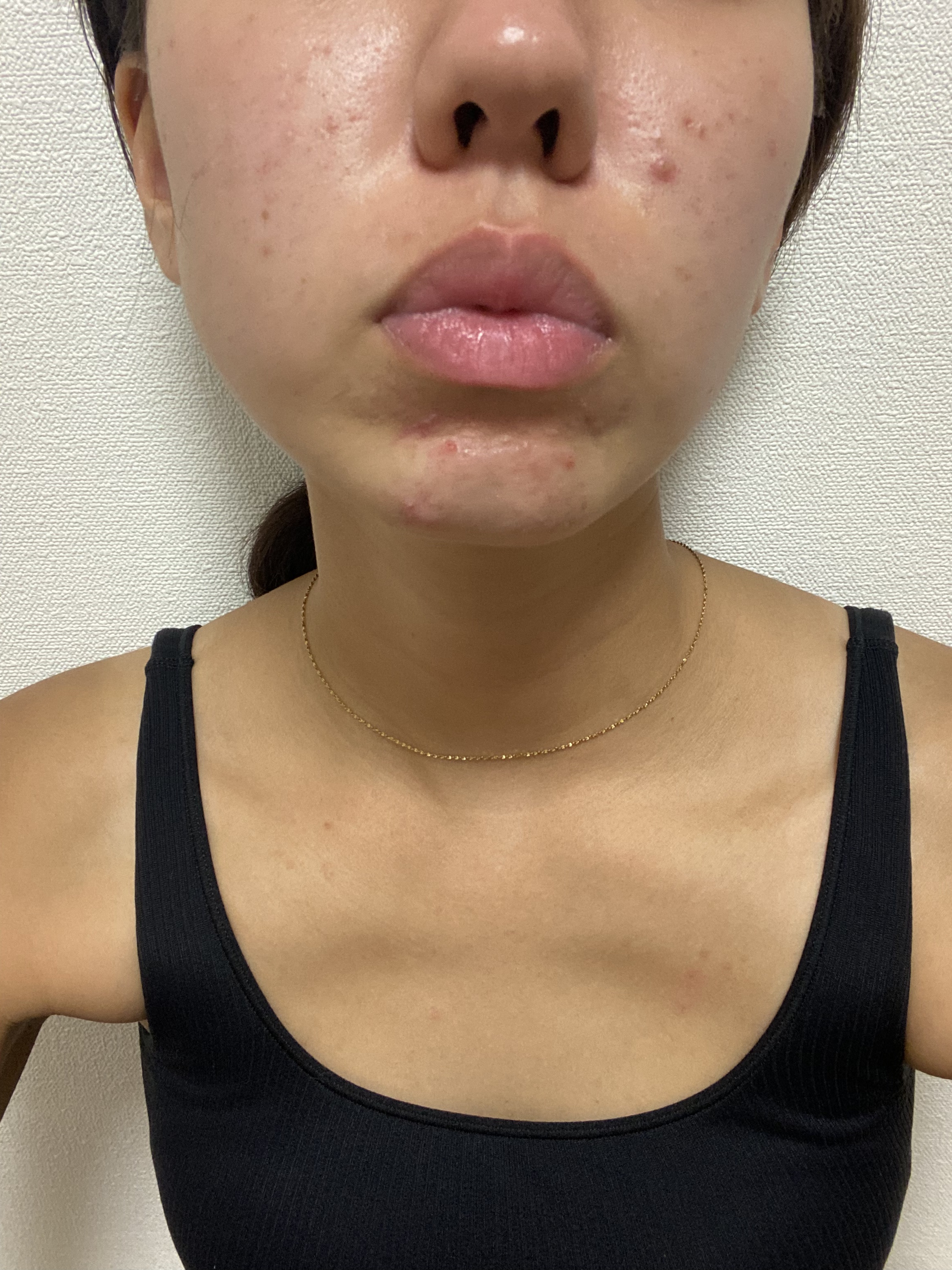 モアリップ N (医薬品)/資生堂薬品/その他を使ったクチコミ（1枚目）