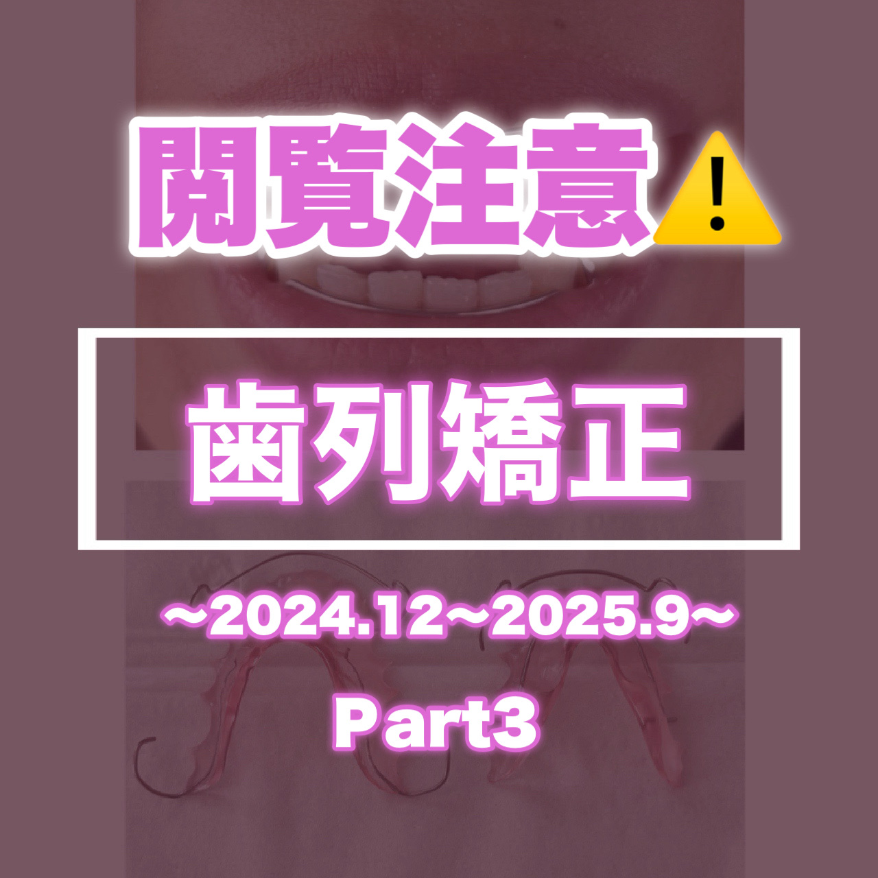 ＼自分用メモ📝／

2024年12月
ヤスリなし。
下の歯の金具を1ヶ所付け替え
(前回帰宅後すぐとれた右下1番奥はつけ直し)
いつも通りワイヤー取り替え
ゴムかけはなし。

2025年1月
まさかの予約忘れで施術なし

2025年2月
