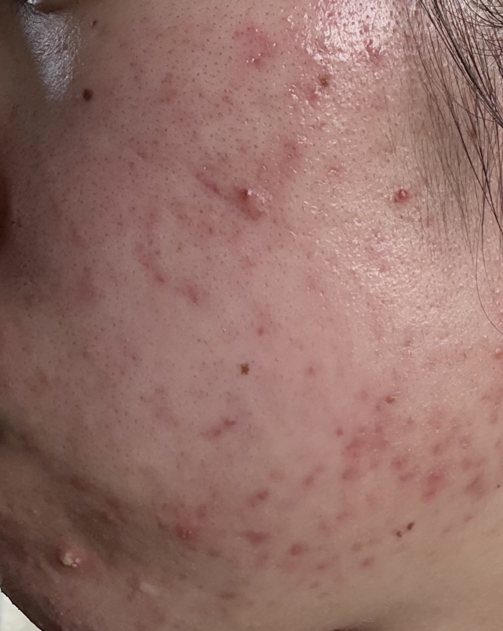 アゼライン酸15 インテンスカーミングセラム/Anua/美容液を使ったクチコミ（3枚目）