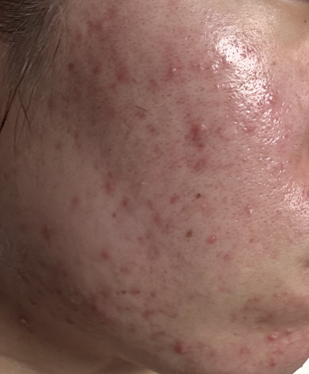 アゼライン酸15 インテンスカーミングセラム/Anua/美容液を使ったクチコミ（2枚目）