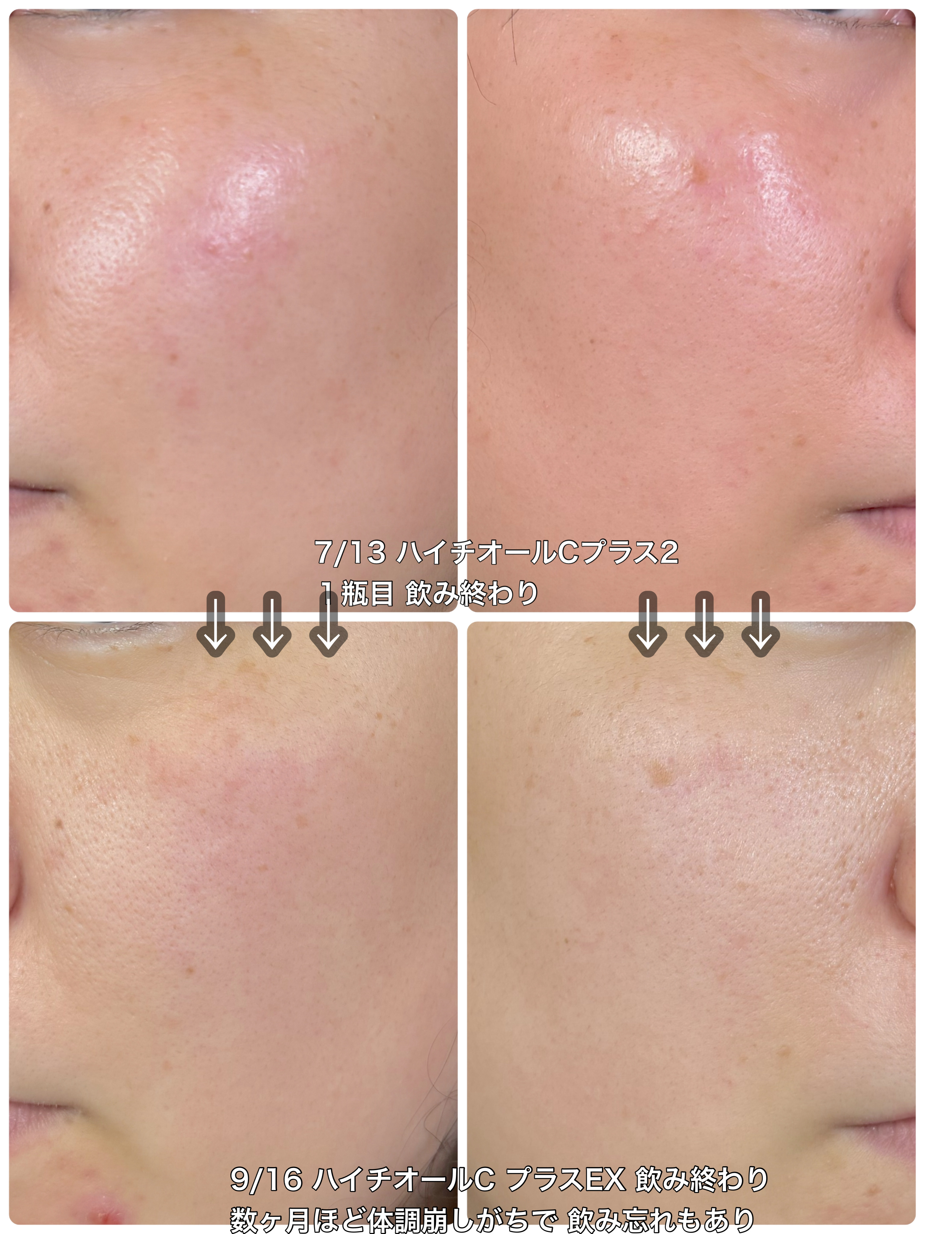 ハイチオールCプラスEX（医薬品）/ハイチオールC/その他を使ったクチコミ（1枚目）