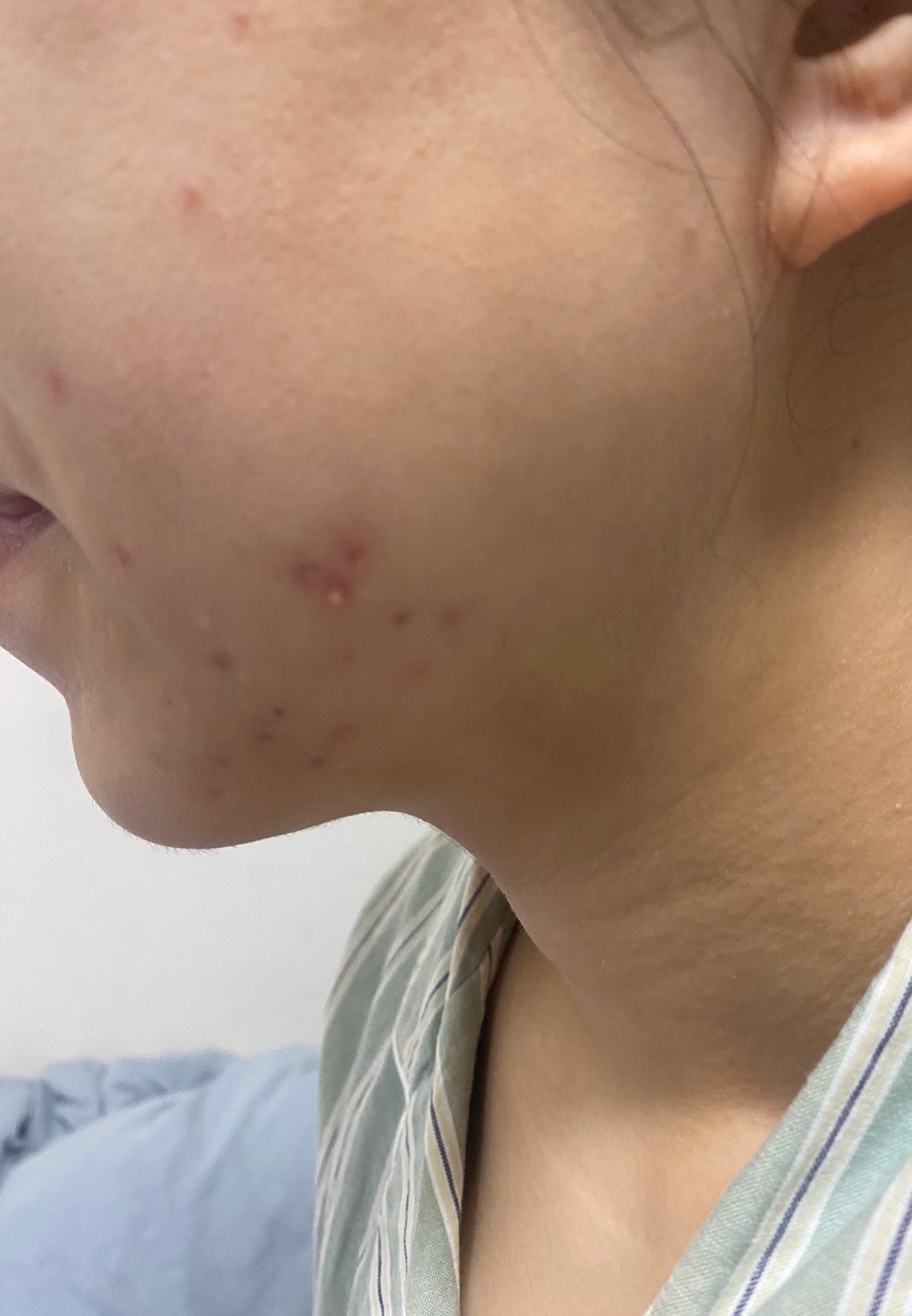 ゆうり on LIPS 「※写真閲覧注意2枚目以降ニキビの肌荒れ写真です。2025.09..」(3枚目)