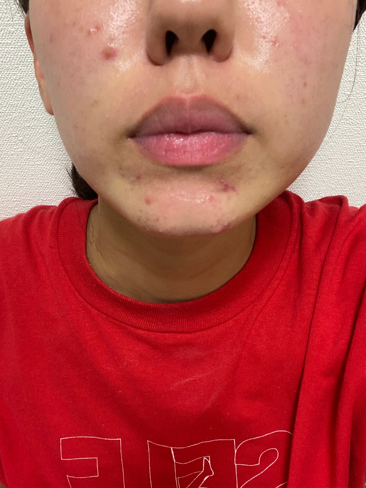 み on LIPS 「イソトレチノイン3日目まだまだ変化はありません。唇の乾燥がひど..」(1枚目)