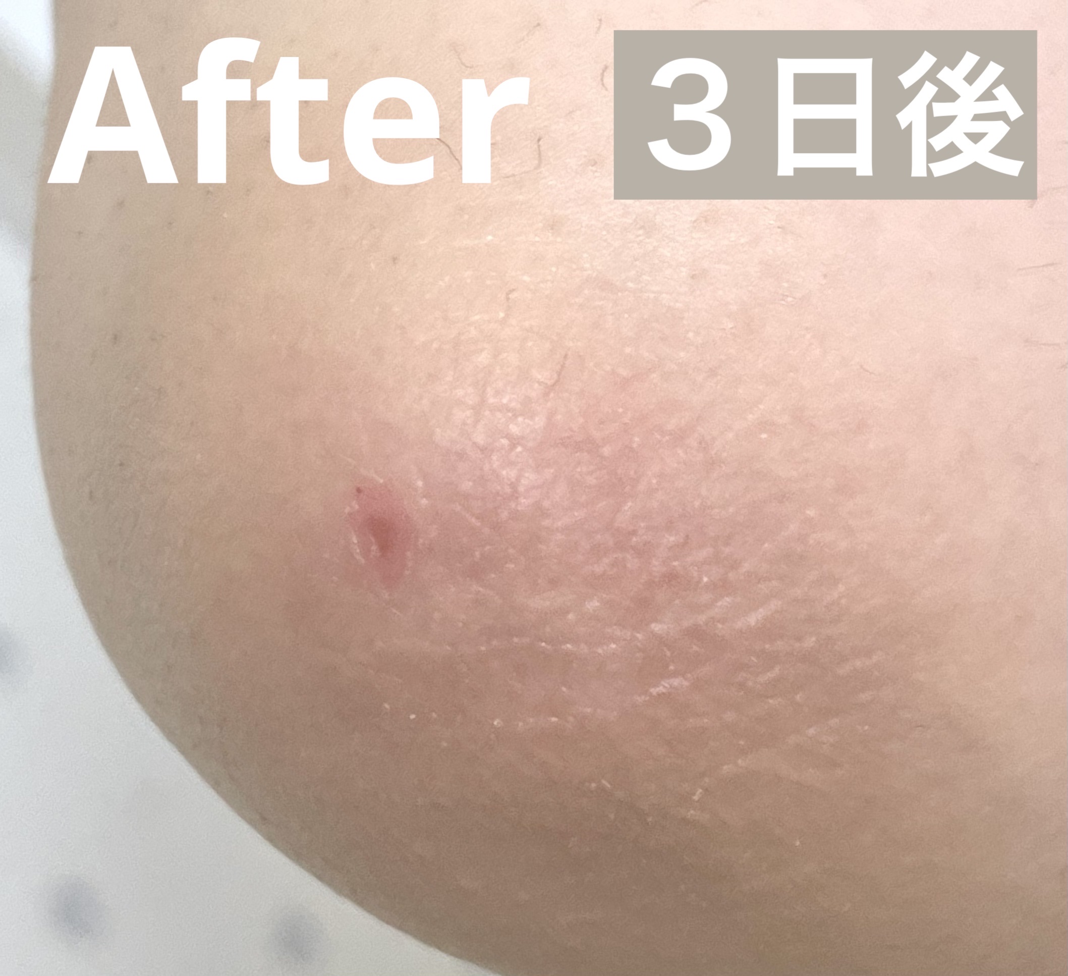 メディータム20E（医薬品）/ラクール/その他を使ったクチコミ（3枚目）