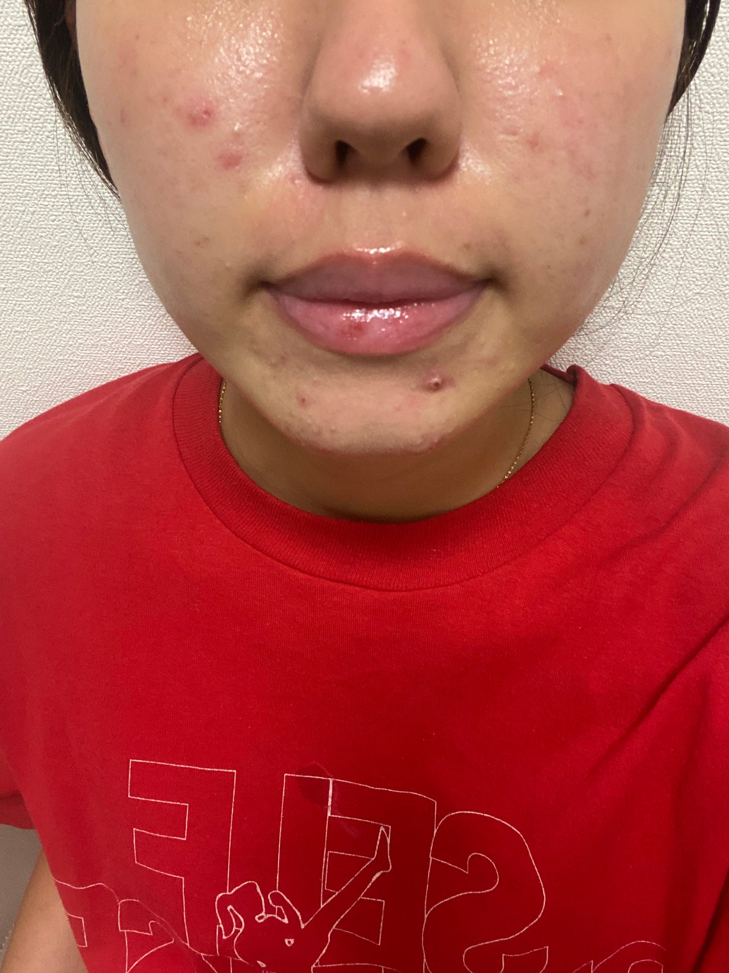 み on LIPS 「イソトレチノイン5日目唇の乾燥がひどくて皮が剥けてしまいます、..」(1枚目)