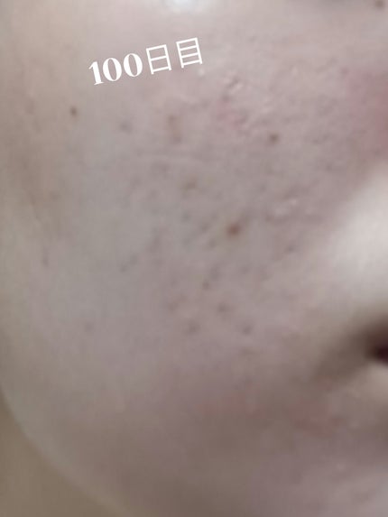 いぬ✢フォロバ100✢ on LIPS 「自分用ニキビ記録100日目ついに100日経ちました!当初に比べ..」(1枚目)