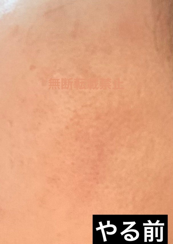 シモ.ヘイヘ田中フォロバ100 on LIPS 「三週間目突入です。:最近は刺激に慣れて、頬に一滴ずつ付けていま..」(2枚目)