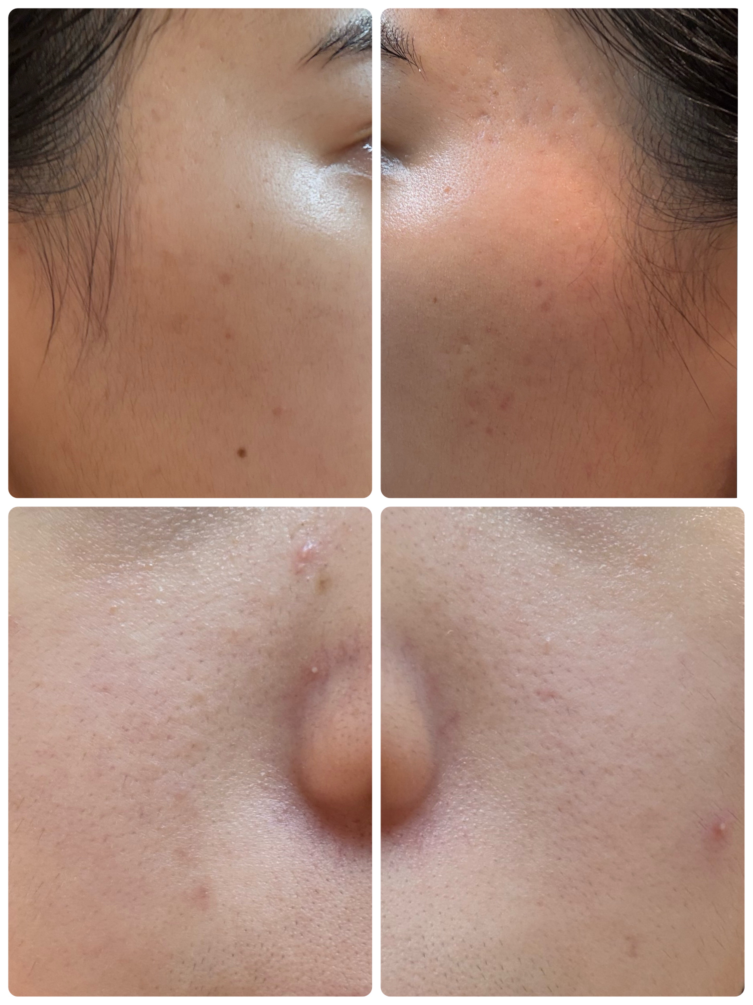 薬用雪肌精 ブライトニング クレンジング オイル[医薬部外品]/雪肌精/オイルクレンジングを使ったクチコミ（2枚目）