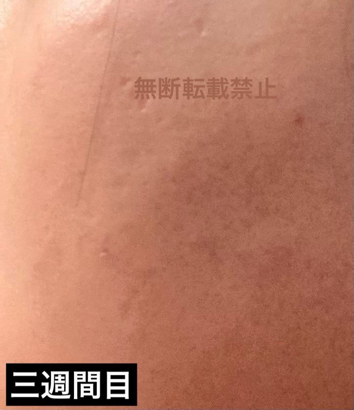 シモ.ヘイヘ田中フォロバ100 on LIPS 「三週間目突入です。:最近は刺激に慣れて、頬に一滴ずつ付けていま..」(3枚目)