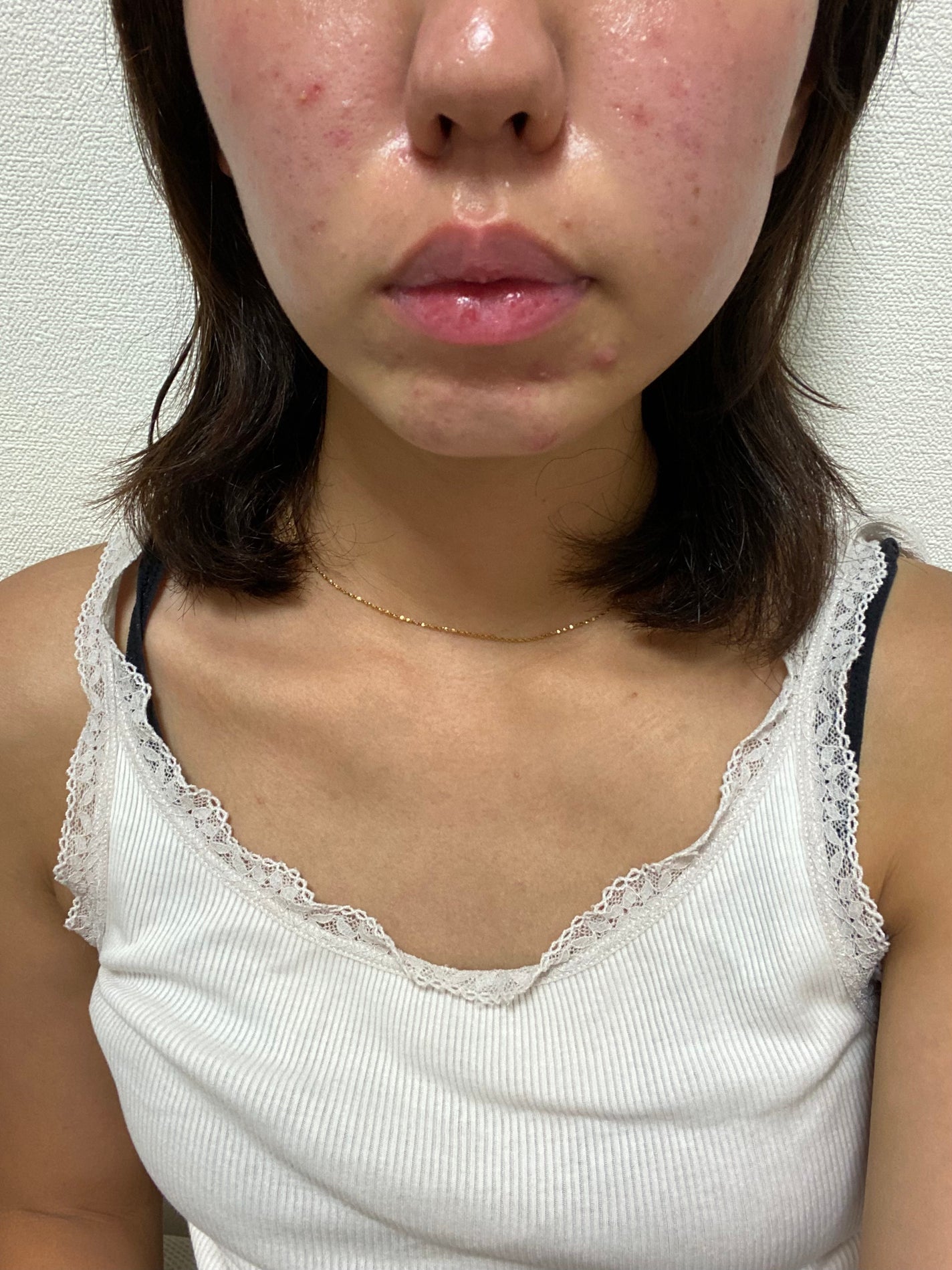 モアリップ N (医薬品)/資生堂薬品/その他を使ったクチコミ(1枚目)