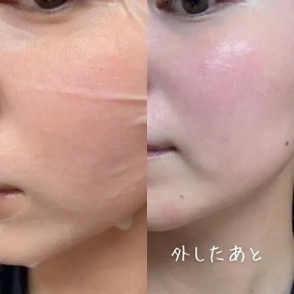 PDRN リフティングマスク/MEDIHEAL/シートマスク・パックを使ったクチコミ(4枚目)