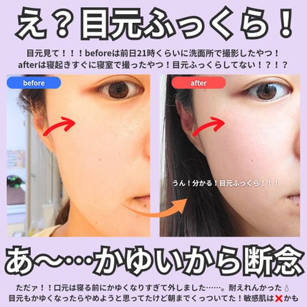 クリアターン ヒアロチューン マイクロパッチ 1500/クリアターン/シートマスク・パックを使ったクチコミ(4枚目)