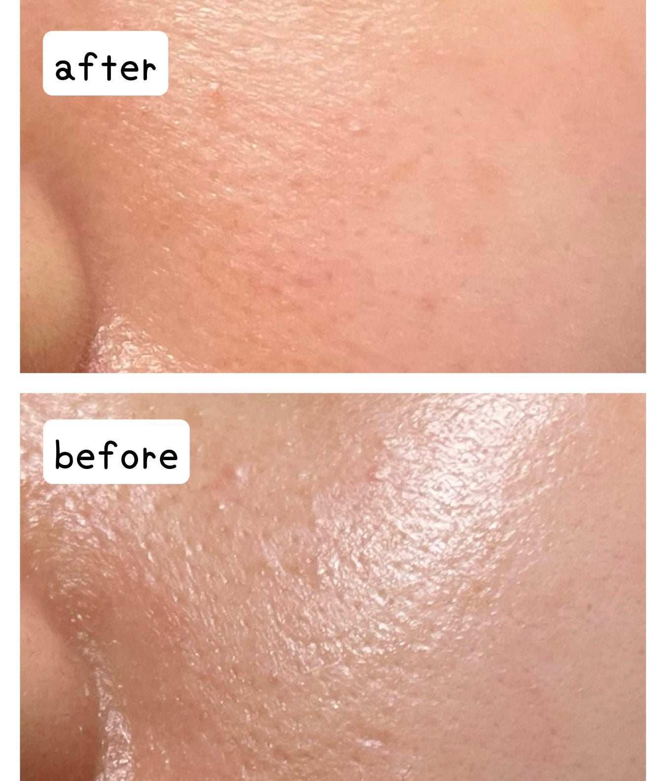 QuSomeレチノA/b.glen/美容液を使ったクチコミ(5枚目)