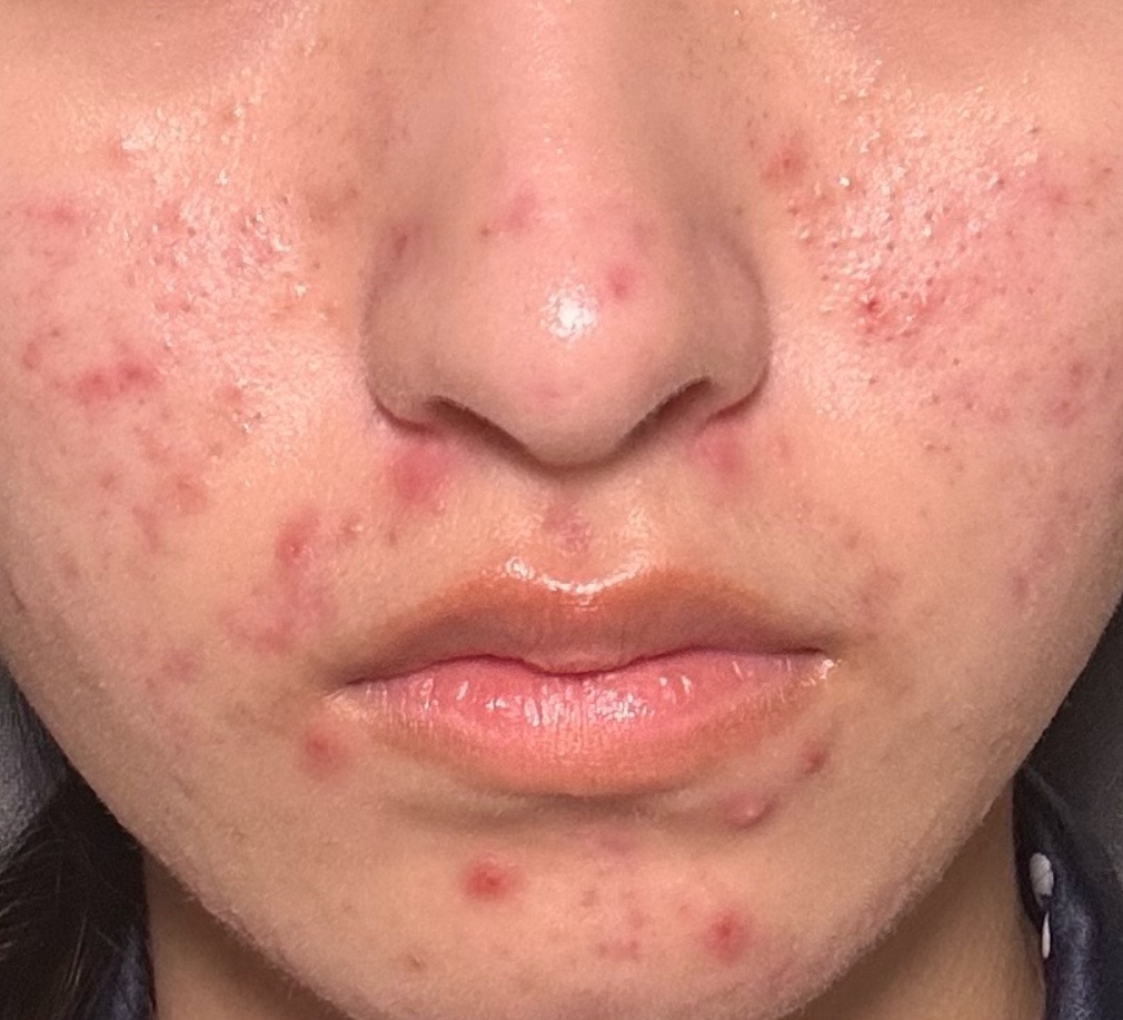 エバユースBBプラスC(医薬品)/第一三共ヘルスケア/その他を使ったクチコミ（2枚目）