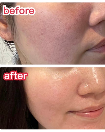 QuSomeレチノA/b.glen/美容液を使ったクチコミ(5枚目)