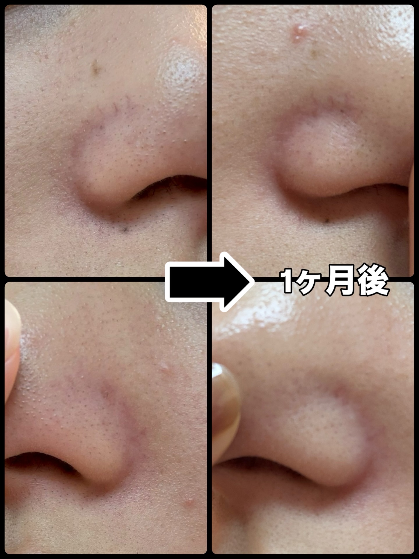 AGE-R ブースタープロ ホワイト（ミニ）/MEDICUBE/美顔器・マッサージを使ったクチコミ（2枚目）