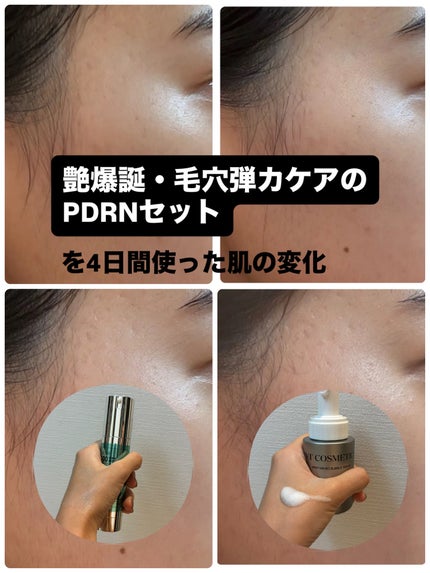 PDRN ヒアルロン酸 ミントマイクロバブルセラム/VT/美容液を使ったクチコミ(1枚目)