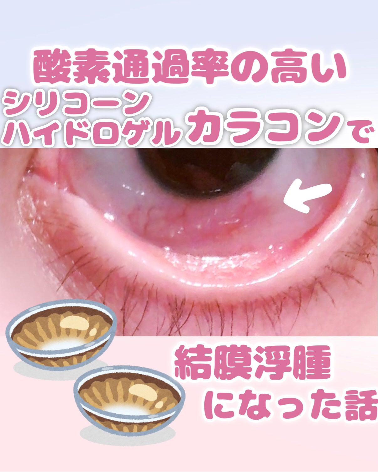 はう on LIPS 「◤⚠️シリコンハイドロゲルカラコンで結膜浮腫になった話💧◢ど..」(1枚目)