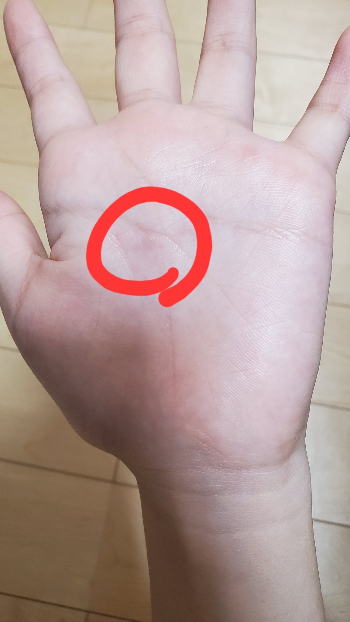 もな | フォロバ100 on LIPS 「水ぶくれ出来ました(´・ω・`)めちゃくちゃ痛い🤕なんでこうな..」(1枚目)