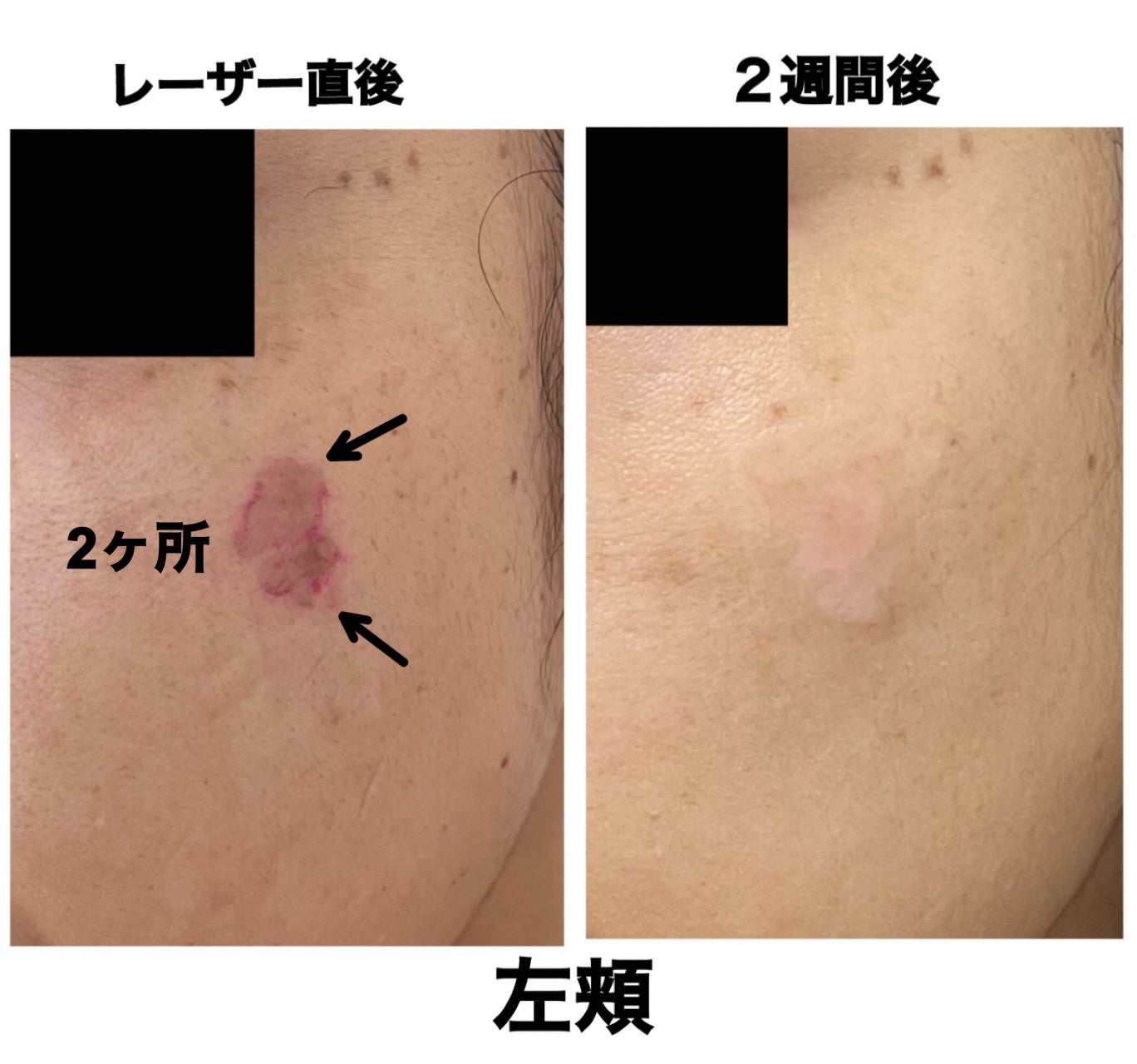 UVミルクEX/NOV/日焼け止めミルクを使ったクチコミ(10枚目)